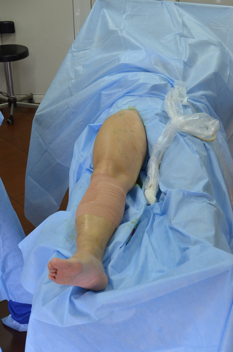 Варикоз вен на ногах лечение в минске