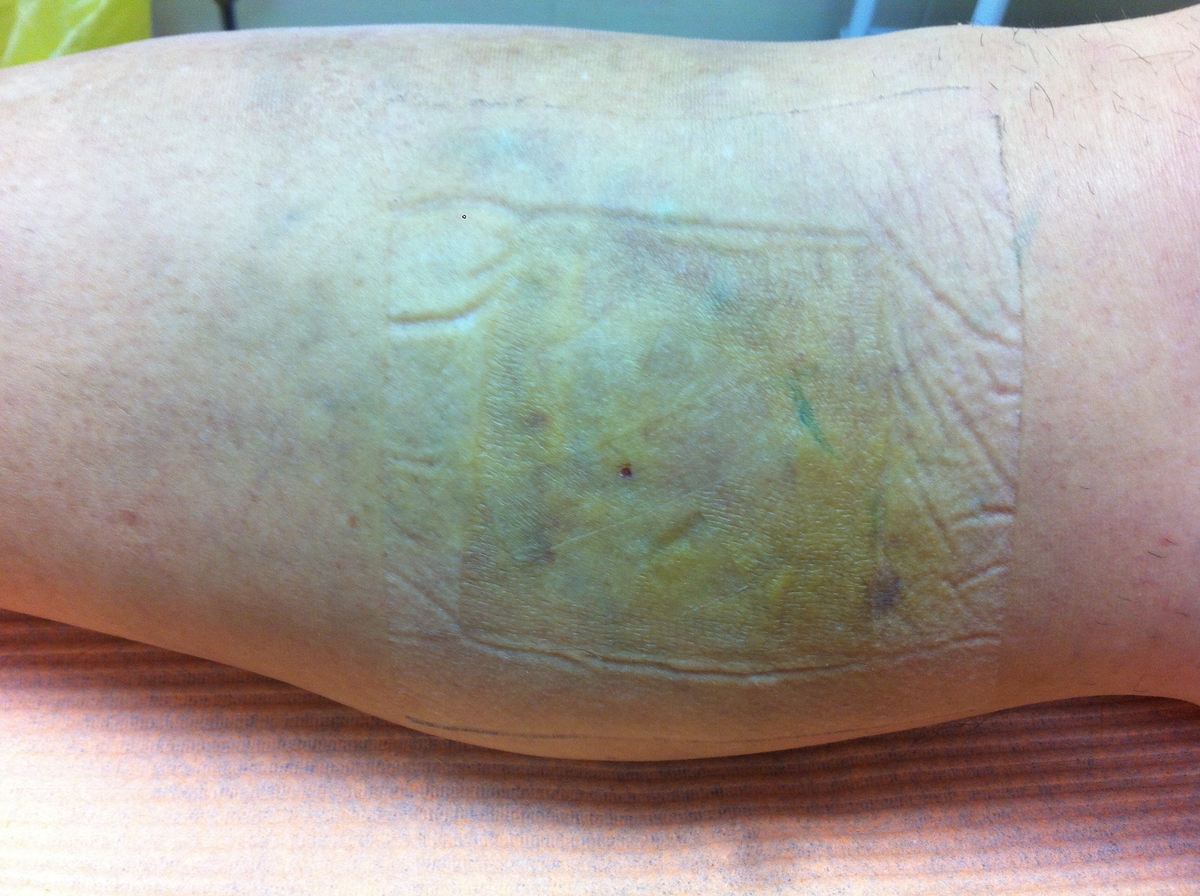 Лечение варикоза вен на ногах лазером цена беларусь